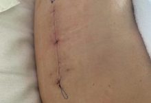 Photo of Операции по замене суставов