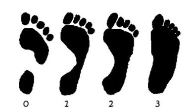 Photo of Как узнать, что у ребенка плоскостопие?