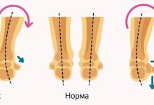 Photo of Когда начинать носить ортопедическую обувь?