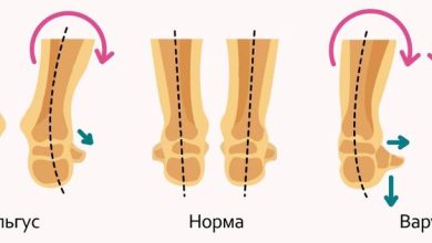 Photo of Когда начинать носить ортопедическую обувь?