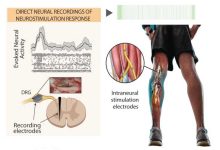 Photo of Протезирование восстановит мобильность после травмы