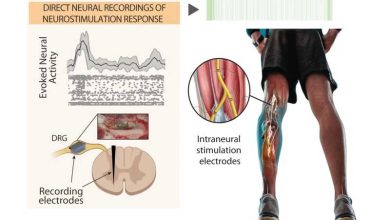 Photo of Протезирование восстановит мобильность после травмы
