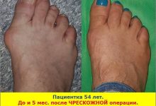 Photo of Последствия ортопедических операций