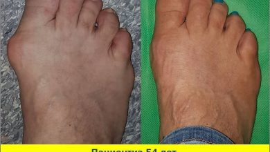 Photo of Последствия ортопедических операций