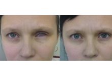 Photo of Протезирование глаз после несчастного случая