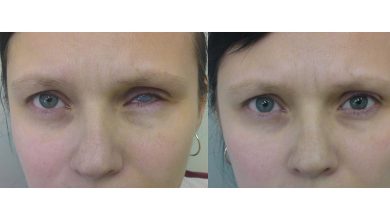 Photo of Протезирование глаз после несчастного случая