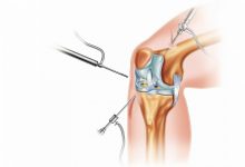 Photo of Виды ортопедических операций