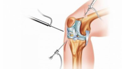 Photo of Виды ортопедических операций