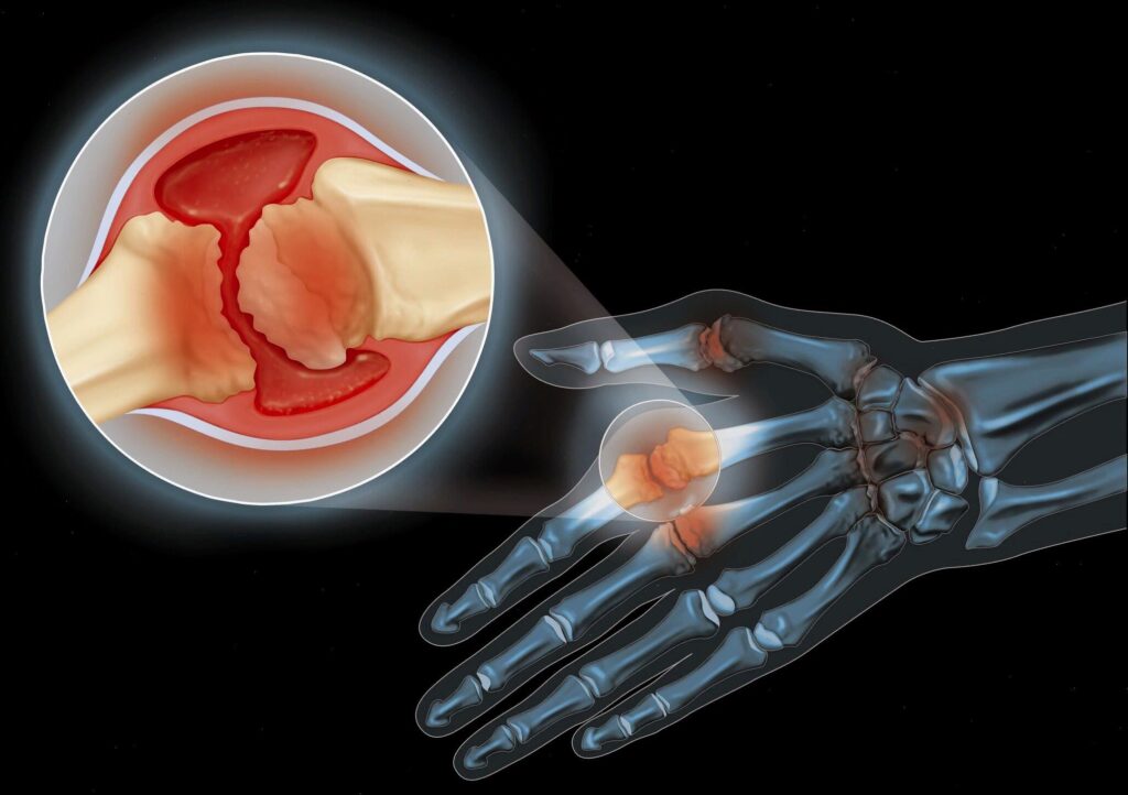 Фото 22 — Лечение артрита без хирургии