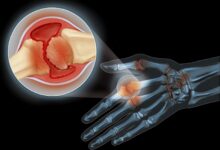 Photo of Лечение артрита без хирургии