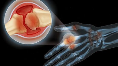 Photo of Лечение артрита без хирургии