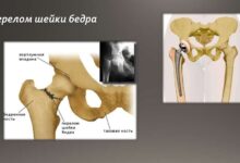 Photo of Как избежать травм суставов