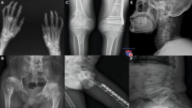 Photo of Здоровье коленных суставов: советы врачей